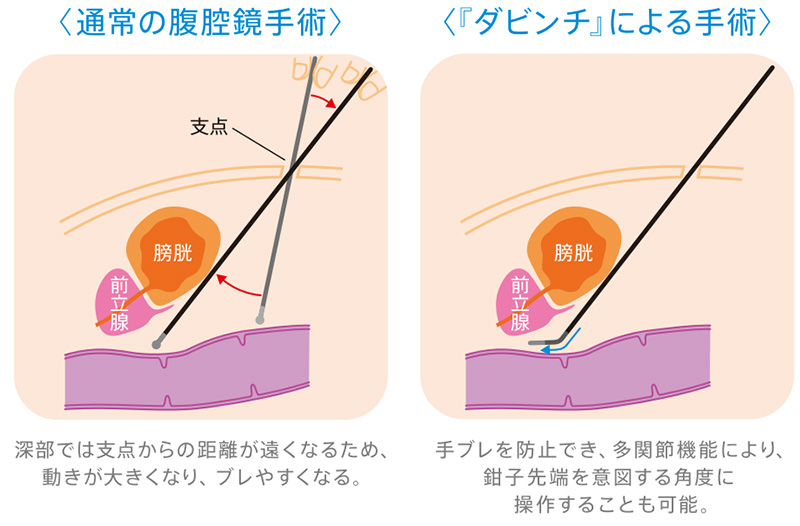 画像：通常の腹腔鏡手術と「ダビンチ」による手術の比較。通常の腹腔鏡手術は深部では支える点からの距離が遠くなるため、動きが大きくなり、ブレやすくなる。「ダビンチ」による手術では、手ブレを防止でき、多関節機能により、鉗子先端を意図する角度に操作することも可能。