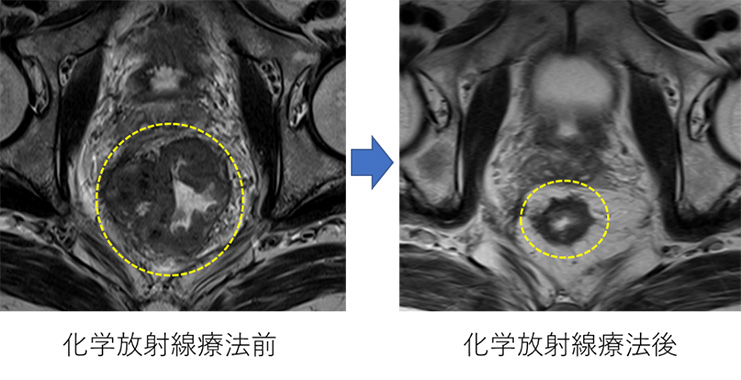 画像：化学放射線療法前と療法後の比較。この画像の療法後においては腫瘍の大きさが4分の1ほどに縮小している。