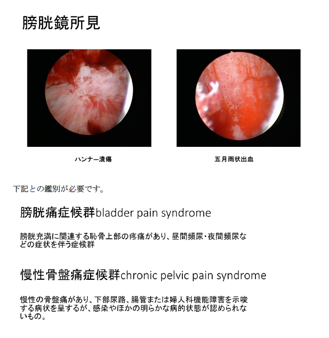 症状 子宮 脱