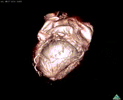 MRI-heart